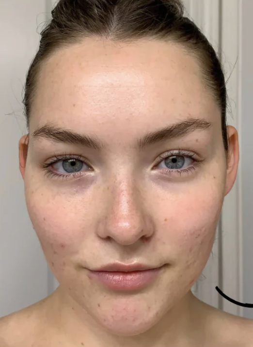 Before Facial