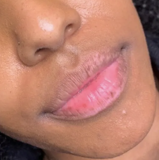 Before Lip Blush